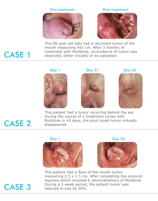 Tumor pictures